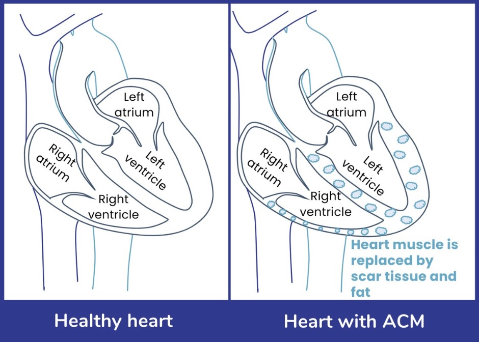 Comparison of a healthy heart and a heart with arrhythmogenic cardiomyopathy. The healthy heart on the left has four chambers: 2 atria and 2 ventricles. Each chamber of the heart is surrounded by muscle which has a healthy size and structure. The heart on the left indicates a heart with arrhythmogenic cardiomyopathy. The heart with arrhythmogenic cardiomyopathy has four chambers: 2 atria and 2 vetricles. In arrhythmogenic cardiomyopathy the heart muscle contains scar tissue. The scarring of the heart muscle changes the structure of the muscle.