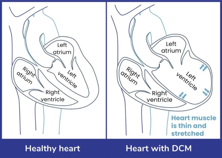 Dilated Cardiomyopathy – NSW Hearts