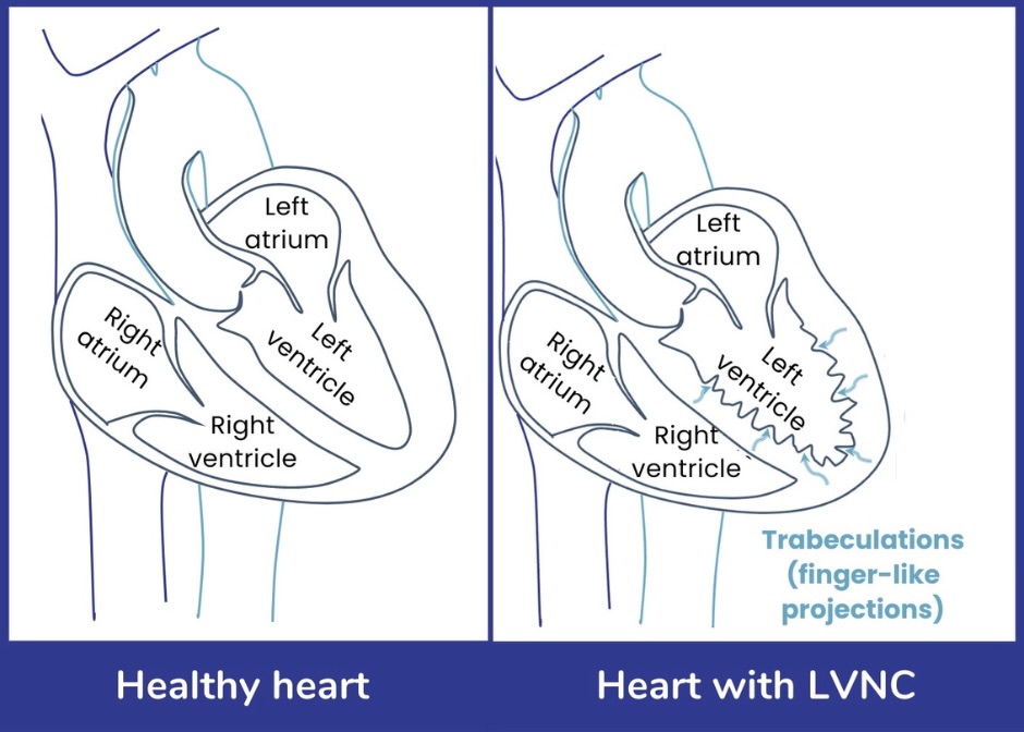 Comparison of a healthy heart and a heart with Left Ventricular Non-Compaction. The healthy heart on the left has four chambers: 2 atria and 2 ventricles. Each chamber of the heart is surrounded by muscle which has a healthy size and structure. The heart on the right indicates a heart with Left Ventricular Non-Compaction, the heart has 4 chambers surrounded by muscle. However, the muscle towards the bottom of the heart is thick and has finger shaped projections into the chamber.