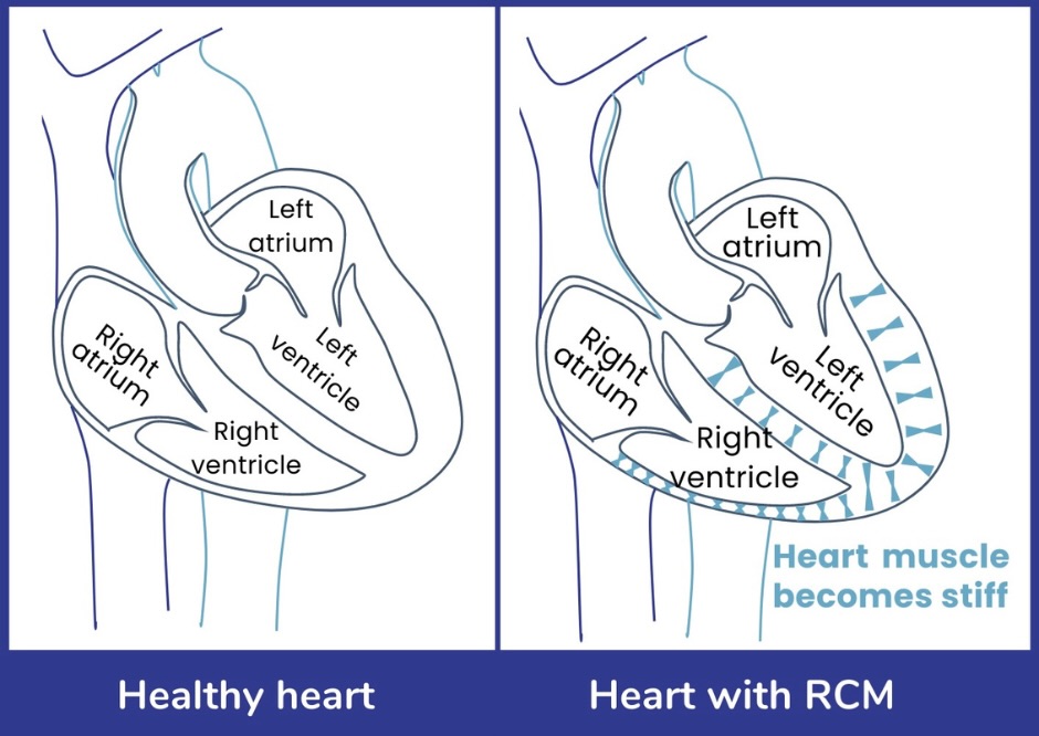 Comparison of a healthy heart and a heart with restrictive cardiomyopathy. The healthy heart on the left has four chambers: 2 atria and 2 ventricles. Each chamber of the heart is surrounded by muscle which has a healthy size and structure. The heart on the right indicates a heart with restrictive cardiomyopathy, the heart has 4 chambers surrounded by muscle. However, the muscle of the heart is stiff and rigid.